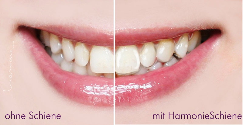 Unsichtbare Zahnspange von Zahnarzt Wellmann Bad Homburg