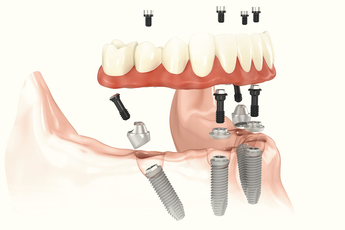 All on 4 Implantate von Zahnarzt Wellmann